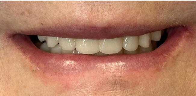 Restorative Care — patient's teeth after treatment at Cloud Family Dental