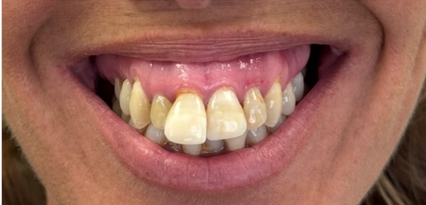 Dental Implants — patient's teeth before treatment at Cloud Family Dental