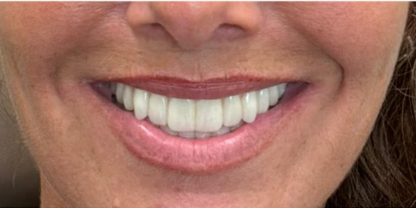 Dental Implants — patient's teeth after treatment at Cloud Family Dental