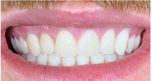 Smile Makeover — patient's teeth after treatment at Cloud Family Dental
