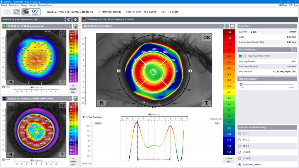 Myopia Ortho-K Demo