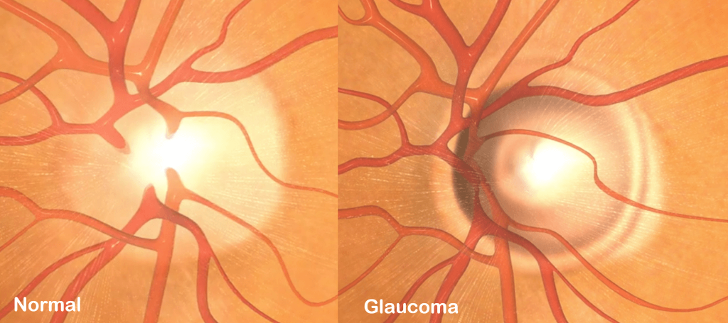 Glaucoma