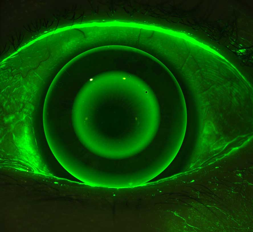 Contact Lenses & Myopia Control