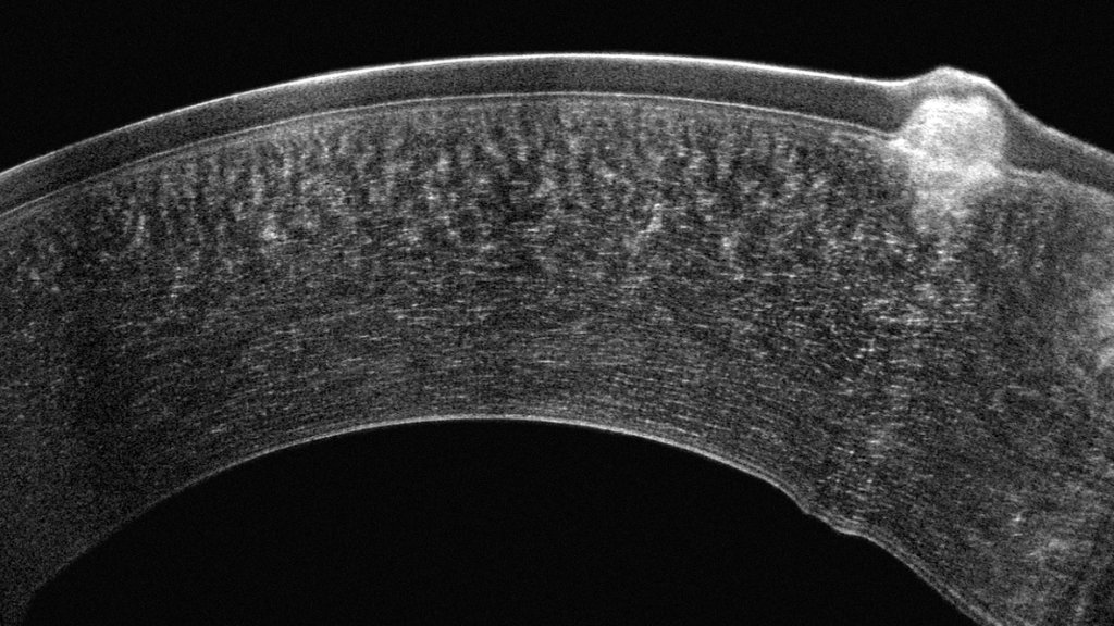Pentacam Cornea OCT scan 5