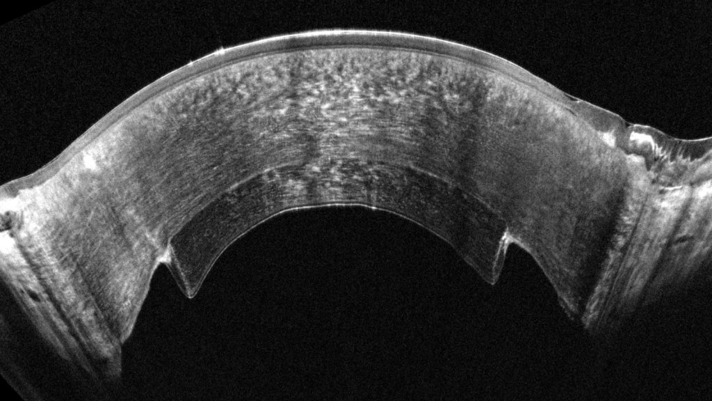 Pentacam Cornea OCT scan 7