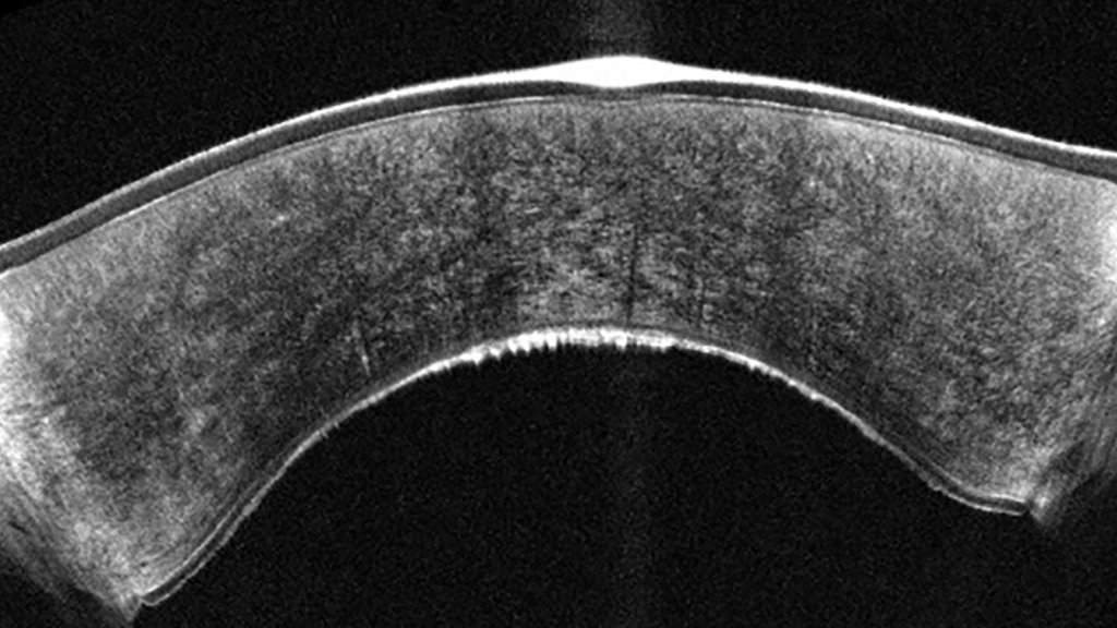 Pentacam Cornea OCT scan 3