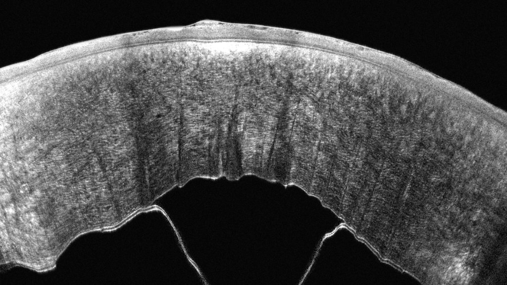 Pentacam Cornea OCT scan 6