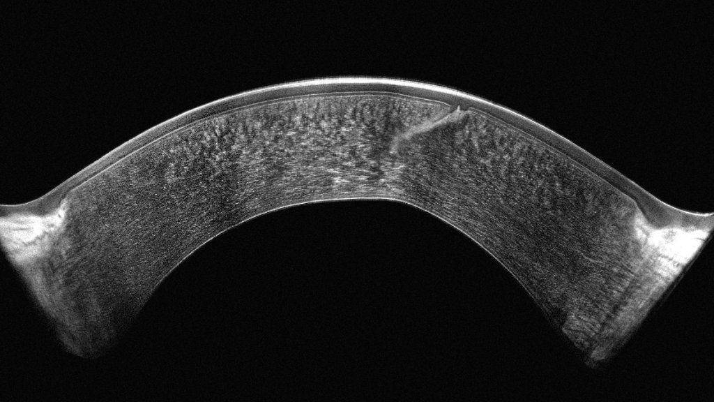 Pentacam Cornea OCT scan 2