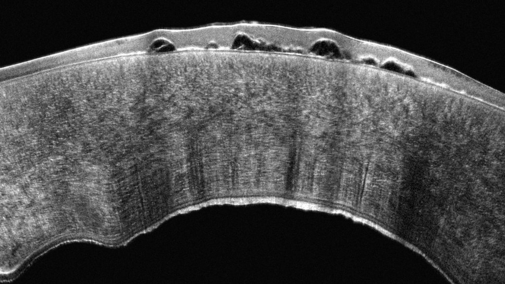 Pentacam Cornea OCT scan 4