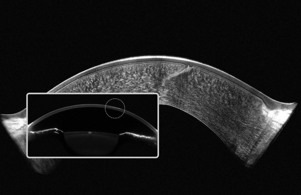 Pentacam Cornea OCT scan 1