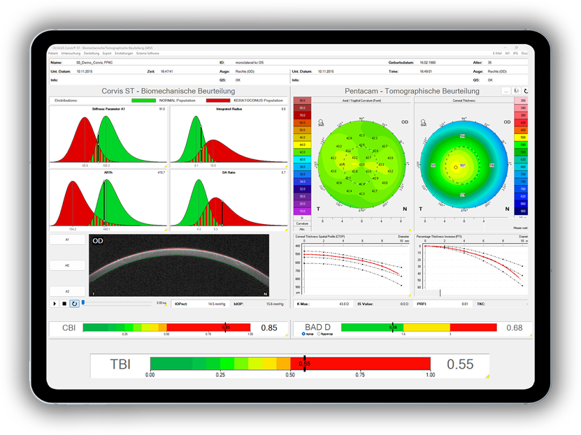 OCULUS Corvis® ST image 1