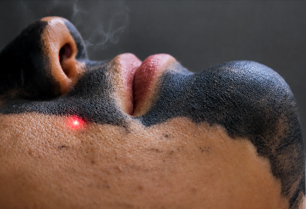 Carbon Laser Facial
