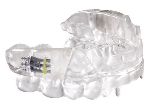 Dynaflex Dorsal Milled & Accu-Fit