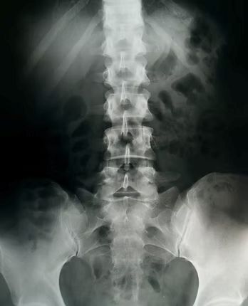 AP lumbar spine X-ray, the clinical foundation of Emily's assessment approach