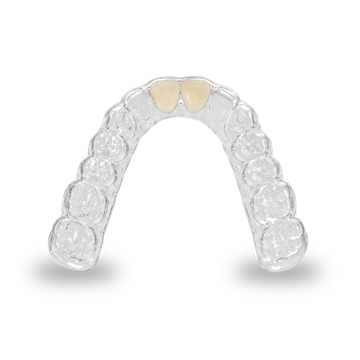 Essix Pontic Retainer