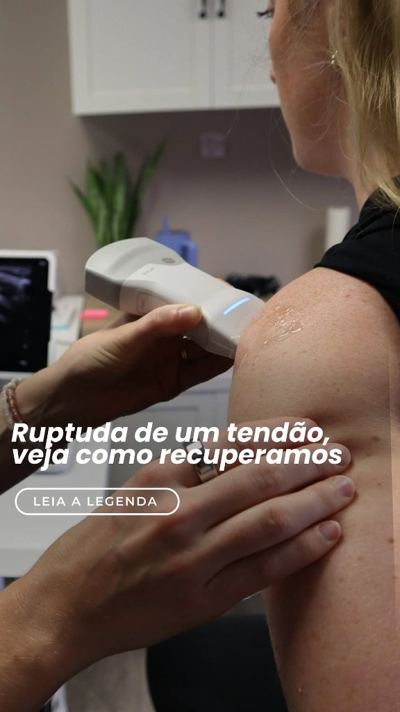 Ruptura do Tendão Supraespinhal