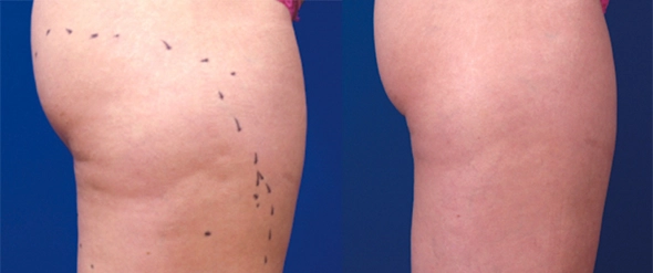 Hips & Thighs before and after