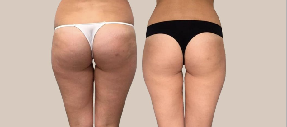 Legs & Buttocks before and after