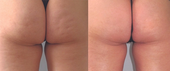 Glutes before and after
