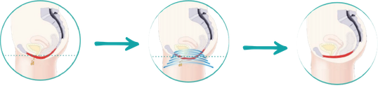 Anatomie-Diagramm der Beckenbodenbehandlung
