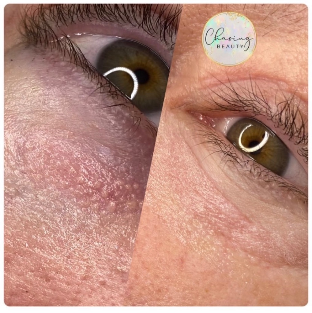 Under Eye Camouflage Result 2