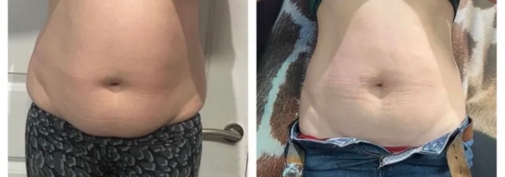 CoolPlas Body Contouring Result 3