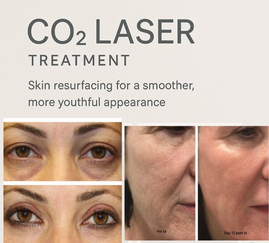 CO2 Laser Resurfacing Result 1