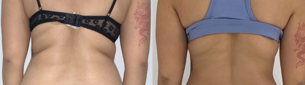 CoolPlas Body Contouring Result 2