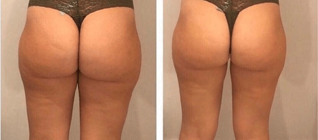 CoolPlas Body Contouring Result 1