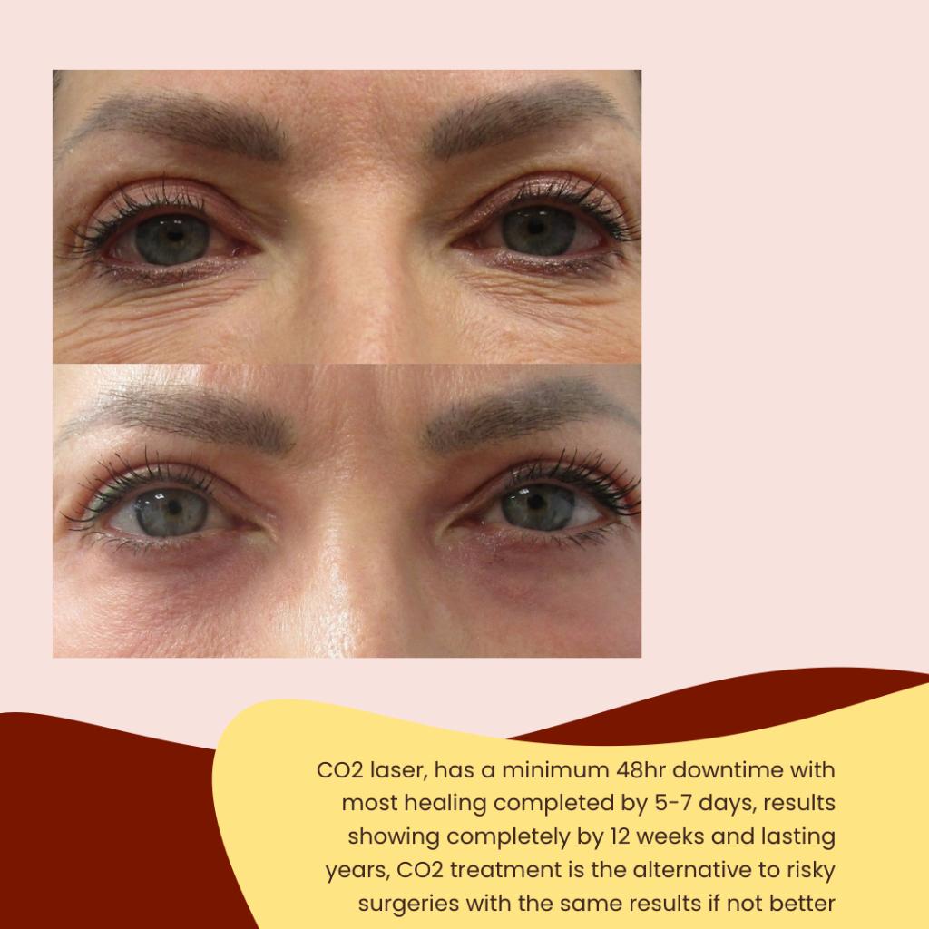 CO2 Laser Resurfacing Result 2