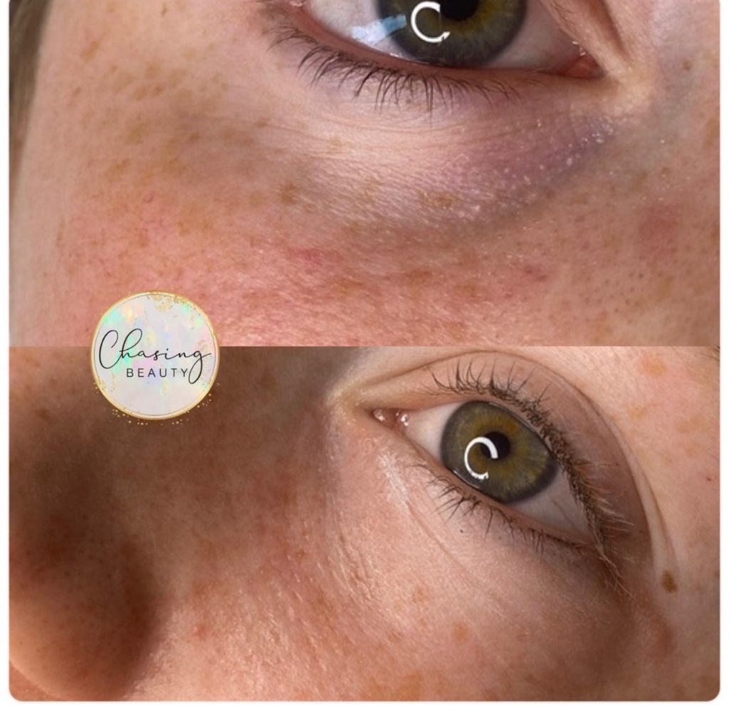 Under Eye Camouflage Result 4