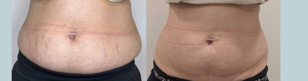 CoolPlas Body Contouring Result 4