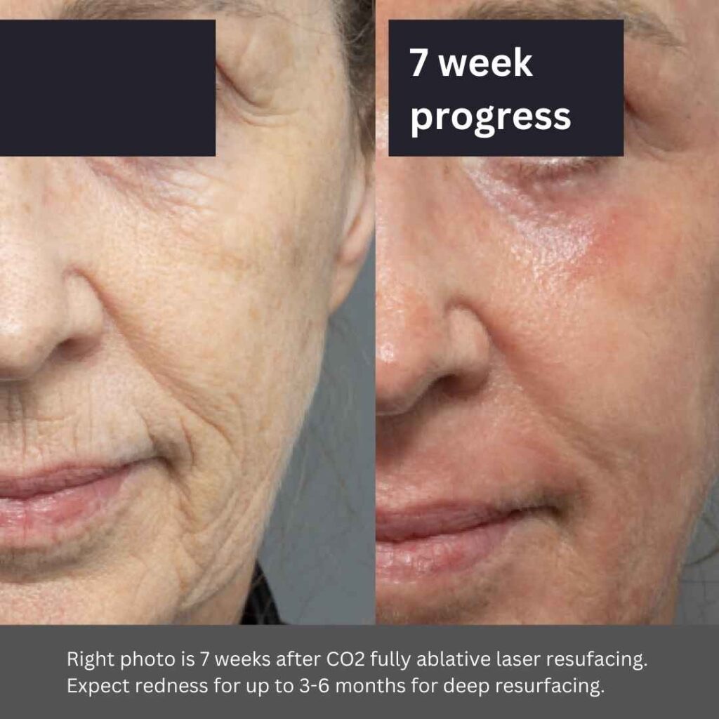 CO2 Laser Resurfacing Result 3
