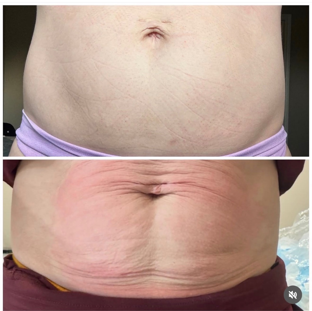 Crystal RF Microneedling