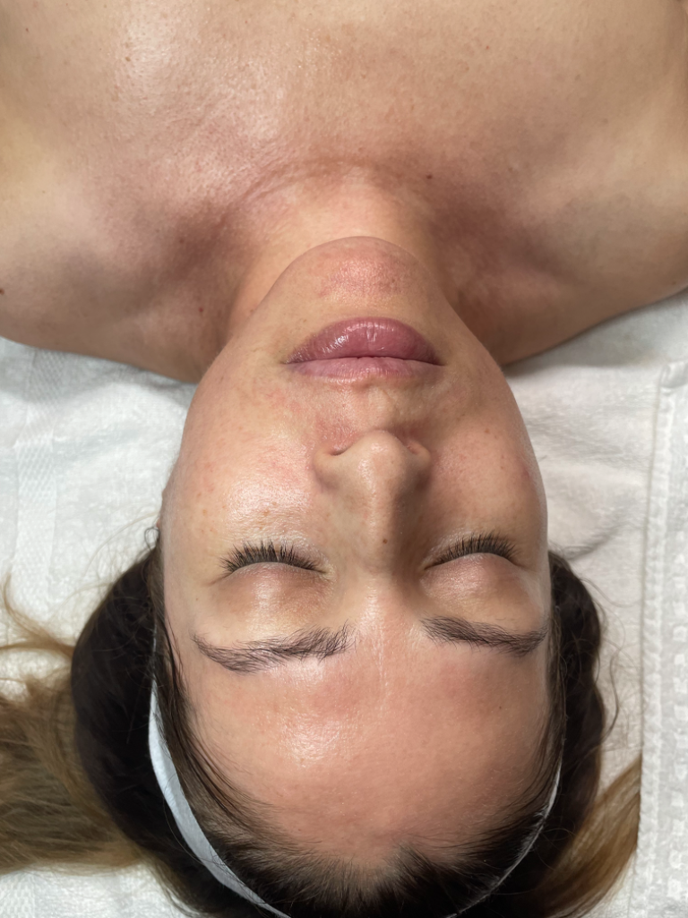 Luxury Dermaplaning Facial before
