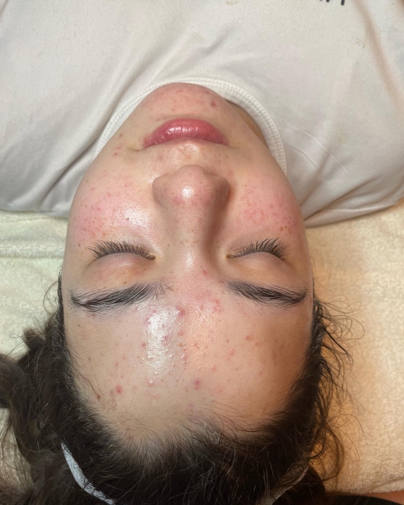 Acne Correction Facial after