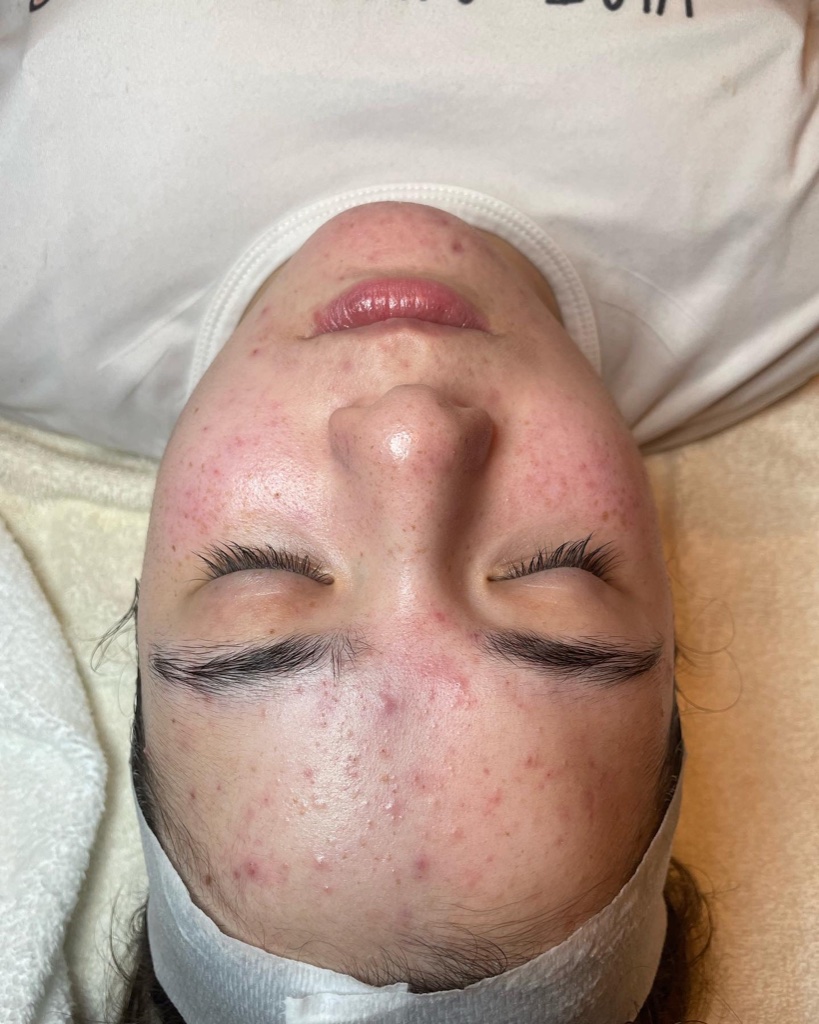 Acne Correction Facial before