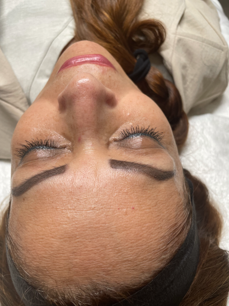 Intensive Hydration Facial before