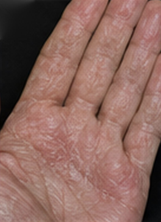 Chronic Hand Eczema