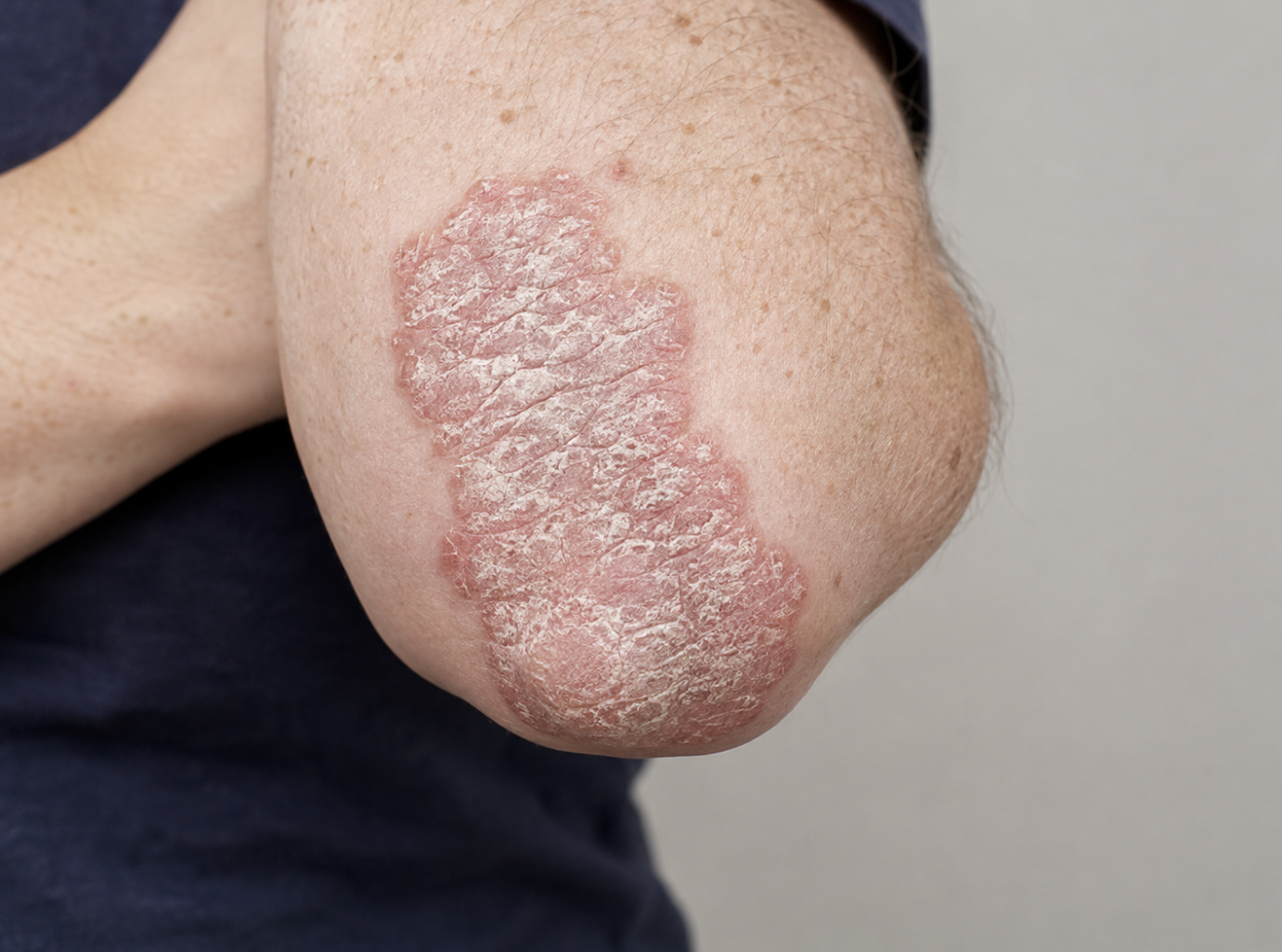 Psoriasis