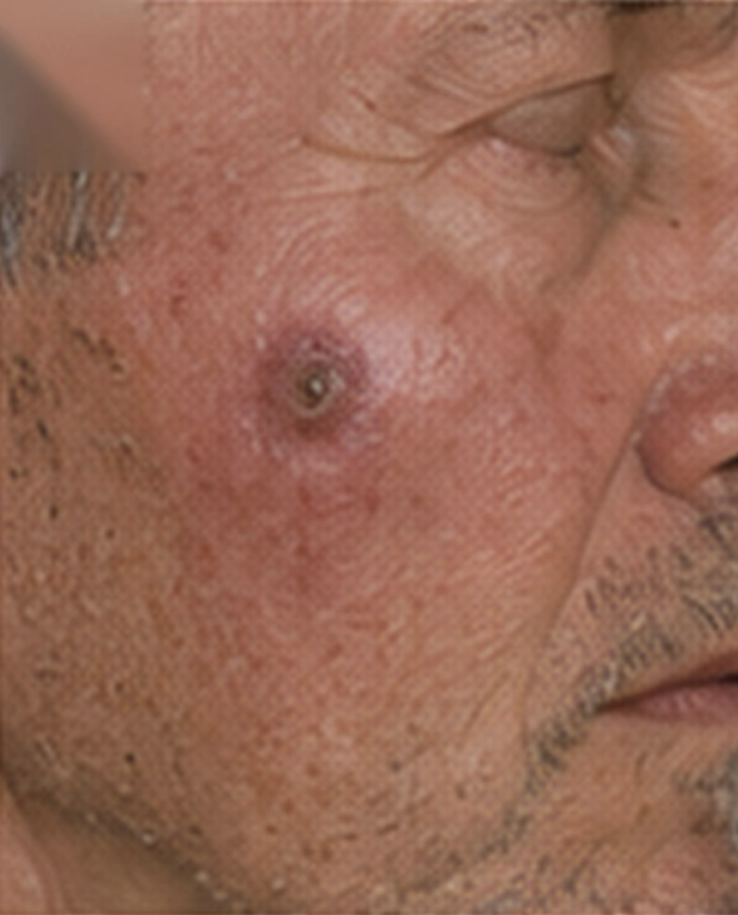 Squamous Cell Carcinoma (SCC)