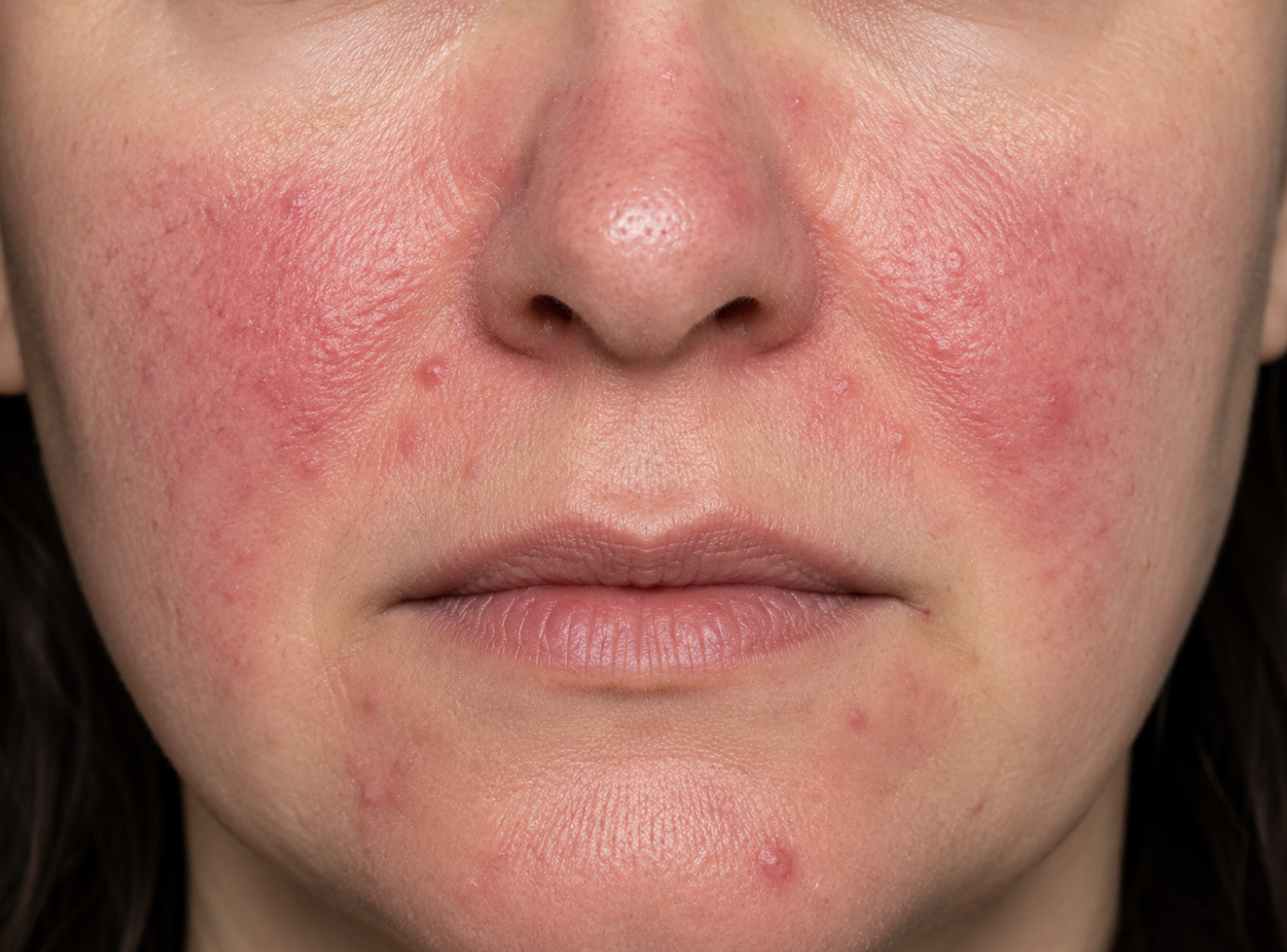 Rosacea