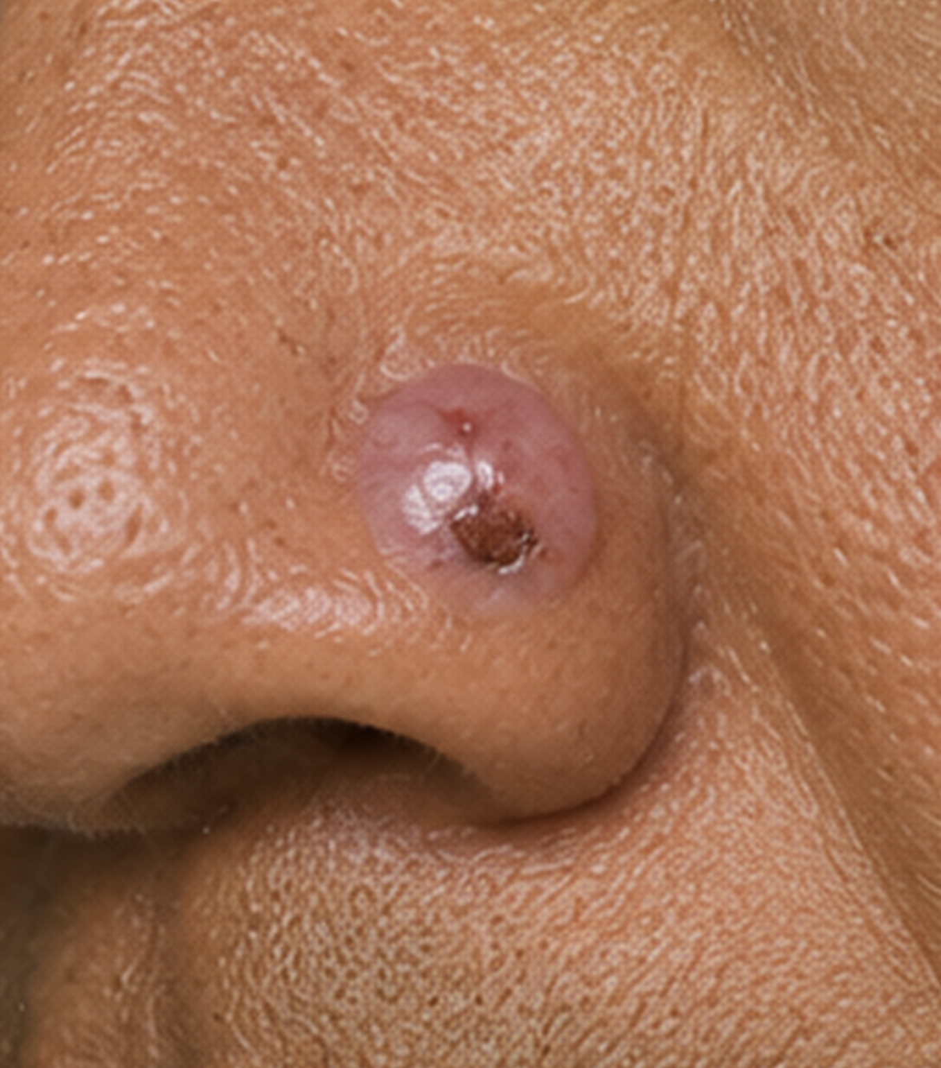 Basal Cell Carcinoma (BCC)