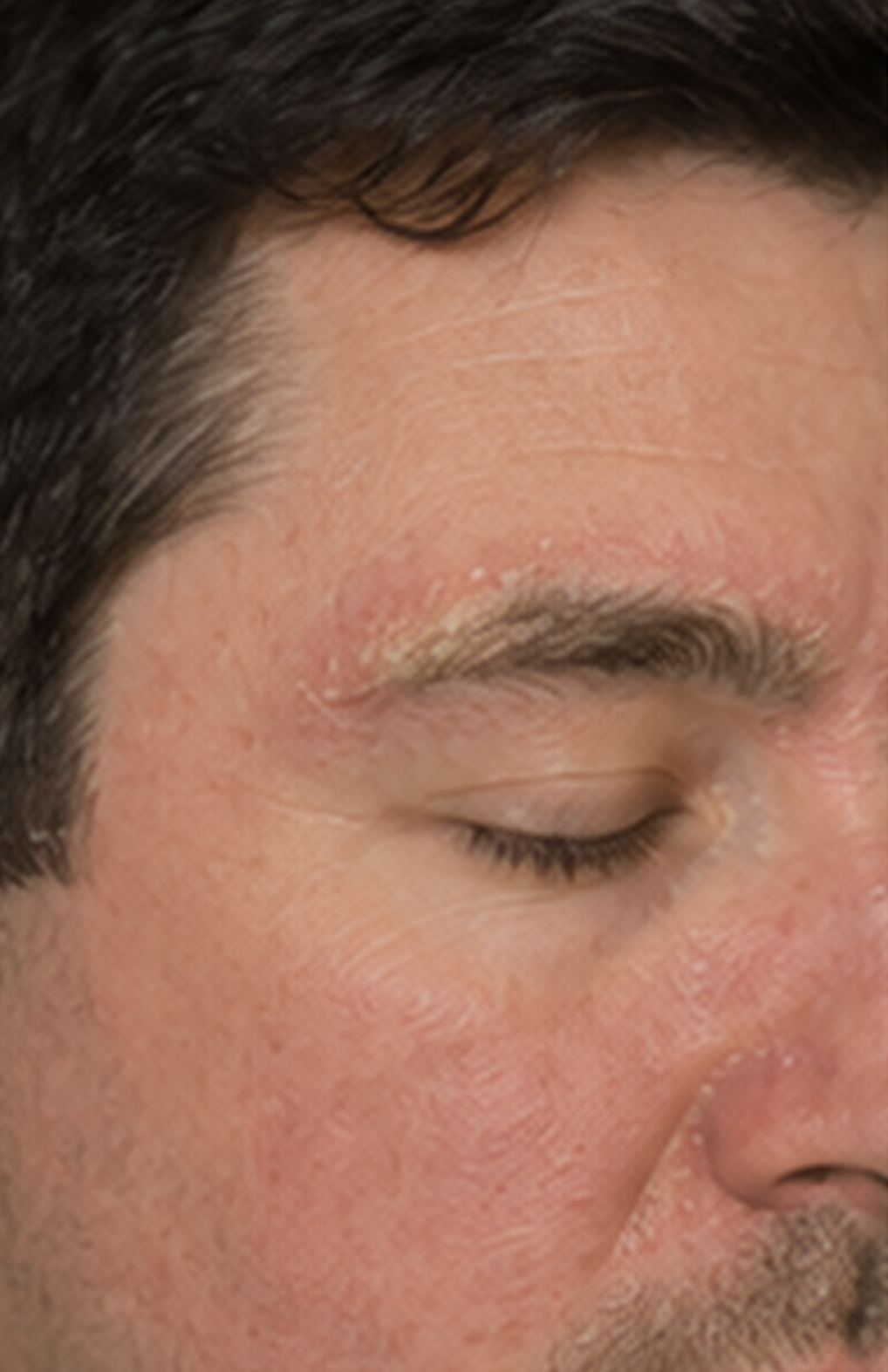 Seborrheic Dermatitis/Dandruff