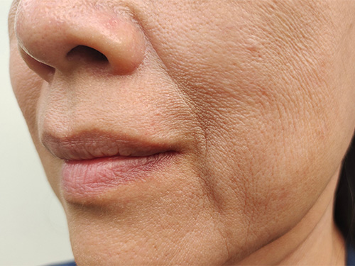 Skin Laxity & Loss of Firmness
