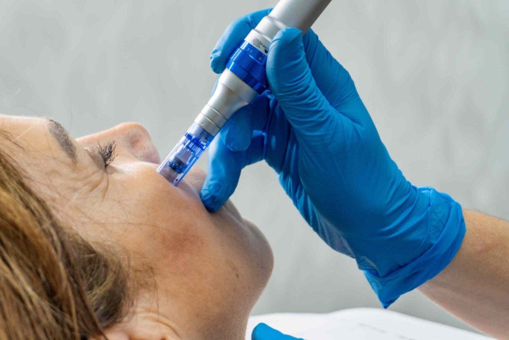 What is Microneedling? A Complete Guide