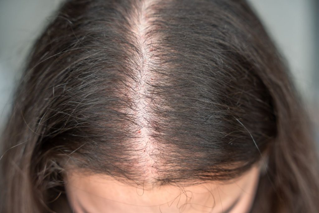 Hair Thinning & Hair Loss