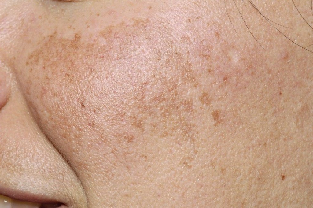 Pigmentation & Uneven Skin Tone