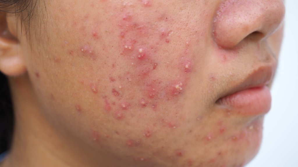 Acne & Breakout Management