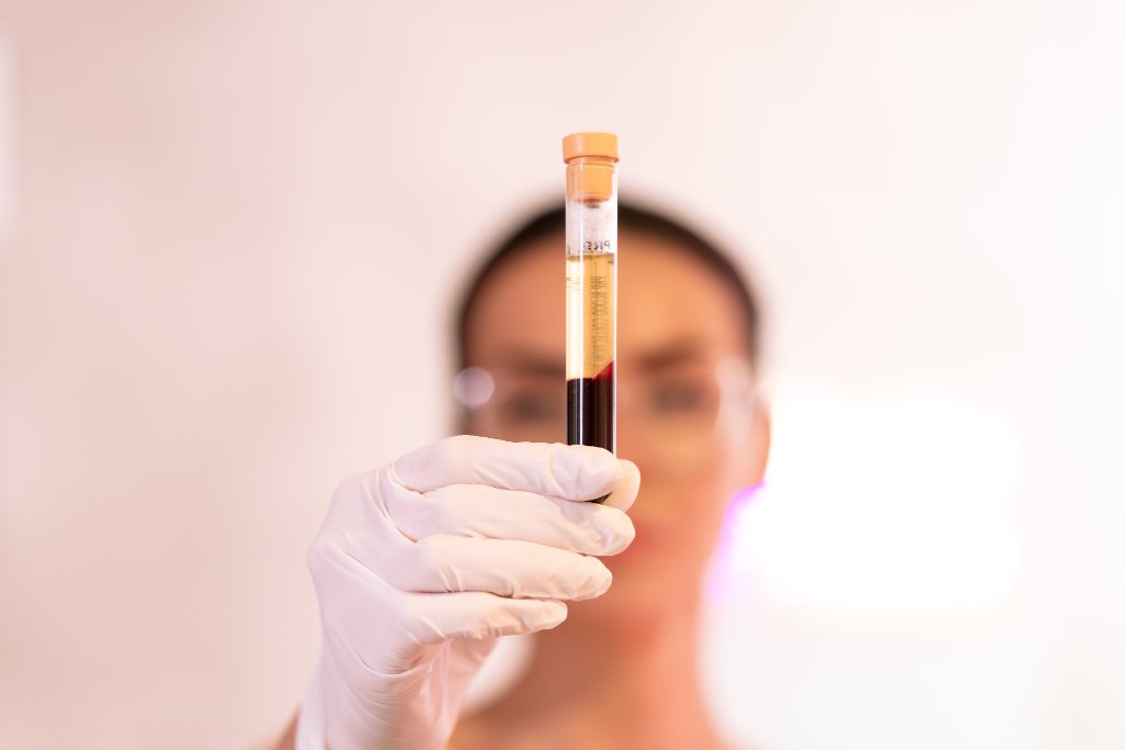 PRP Hair Therapy
